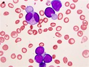 Transient myeloproliferative disorder