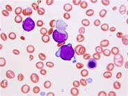 Transient myeloproliferative disorder