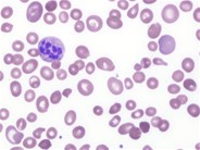 Severe vitamin B12 deficiency mimicking thrombotic thrombocytopenic purpura