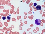 Building bridges to diagnosis and malignancy