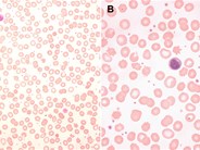 Functional hyposplenism diagnosed by blood film examination