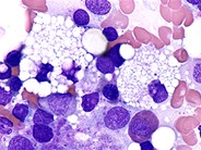 Foamy Histiocytes - 1.