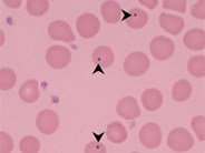 Howell Jolly Bodies in chronic graft vs host disease
