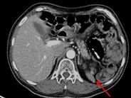 Splenic Atrophy in Chronic GVHD