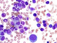Basophilic blast phase of chronic myelogenous leukemia