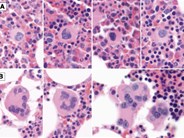 Coexistent BCR-ABL1 and JAK2 V617F: converting CML dwarves to ET staghorns with imatinib therapy