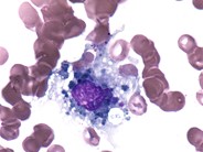 Debris laden histiocytes - 1.