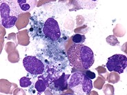 Debris laden histiocytes - 2.