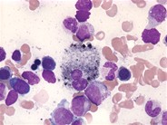 Debris laden histiocytes - 3.