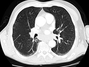 Pulmonary embolism - 1.