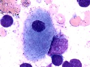 PseudoGaucher-cells--3