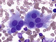 Look alikes: megakaryocyte versus osteoclast - 2.