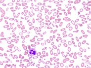 Hereditary pyropoikilocytosis - 1.