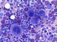 Megakaryocytic hyperplasia - 1.