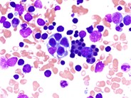 Hematophagocytic lymphohistiocytosis (HLH) in a patient with CLL - 2.
