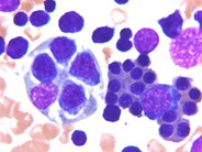 Hematophagocytic lymphohistiocytosis (HLH) in a patient with CLL - 3.