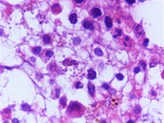 Leishman donovani (LD) bodies in bone marrow biopsy of an adult male with HIV infection - 4.