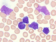 T-prolymphocytic leukemia - 2.