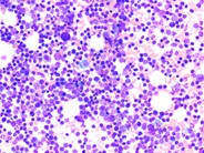 T-prolymphocytic leukemia - 3.