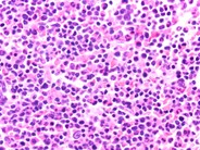 T-prolymphocytic leukemia - 5.