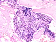 Marrow fibrosis in primary myelofibrosis - 1.