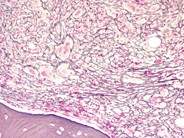 Marrow fibrosis in primary myelofibrosis - 2.