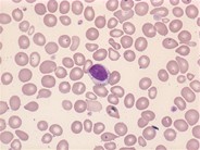 Large granular lymphocyte - 1.