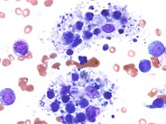 Hemophagocytic lymphohistiocytosis associated with AML-M5a - 3.