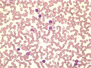 T-cell lymphoblastic leukemia - 1.