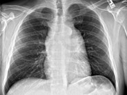 T-cell lymphoblastic leukemia - 3.