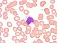 Large granular lymphocytes (LGLs) - 2.