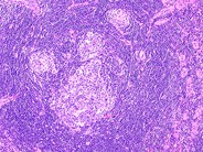 Castleman lymphadenopathy - 1.