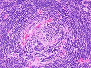 Castleman lymphadenopathy - 3.