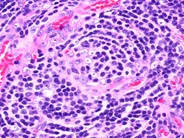 Castleman lymphadenopathy - 4.