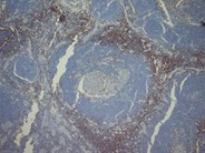 Castleman lymphadenopathy - 6.