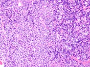 Mantle cell lymphoma - 1.