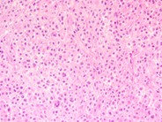 Cutaneous lesions in systemic mastocytosis - 2.