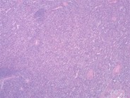 Ruptured spleen due to infectious mononucleosis - 1.