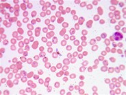 An overwhelming case of malaria in New York City - 1.