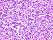 Nodal involvement by adult T-cell leukemia/lymphoma - 2.