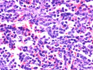 Nodal involvement by adult T-cell leukemia/lymphoma - 3.