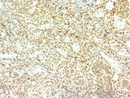 Nodal involvement by adult T-cell leukemia/lymphoma - 4.