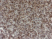 Nodal involvement by adult T-cell leukemia/lymphoma - 5.