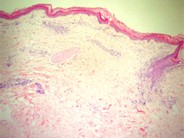 Adult T-cell leukemia/lymphoma involving the skin - 1.
