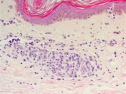 Adult T-cell leukemia/lymphoma involving the skin - 2.