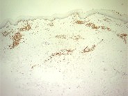 Adult T-cell leukemia/lymphoma involving the skin - 3.