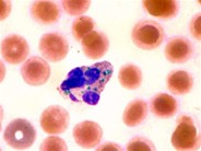 Green Neutrophil Inclusions in a Patient with Liver Disease