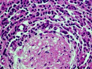 Dural marginal zone lymphoma