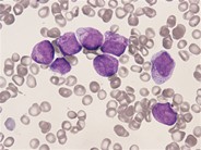Promyelocytes with Auer rods - 03