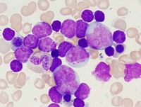 Mixed-phenotype-acute-leukemia-with-t922q34q2112-BCRABL-Aspirate